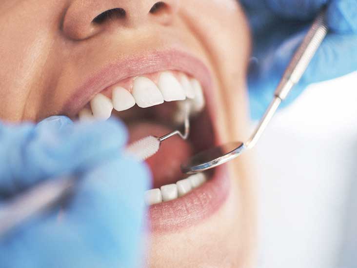 Full mouth dental implant